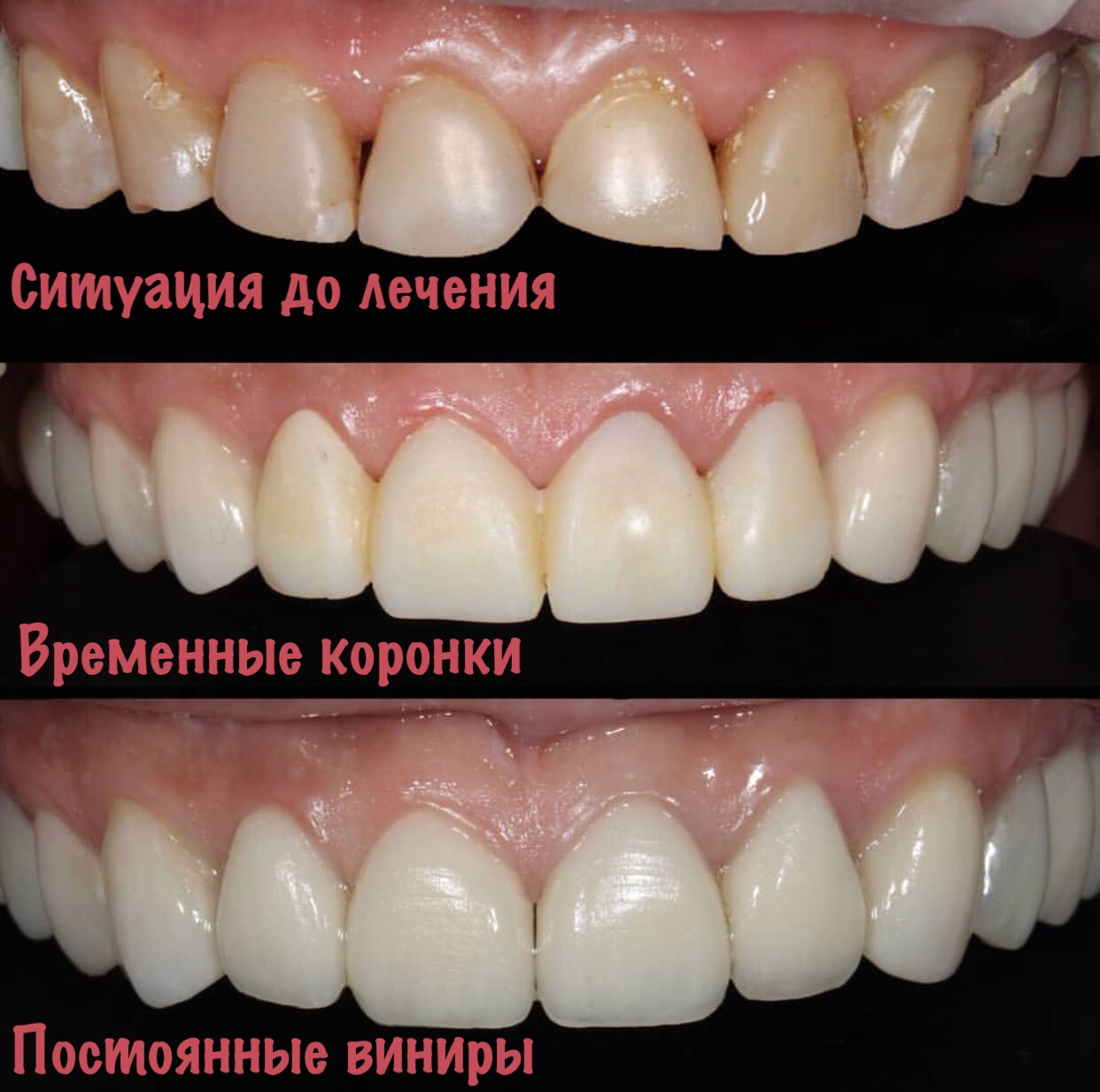 обточка зубов фото
