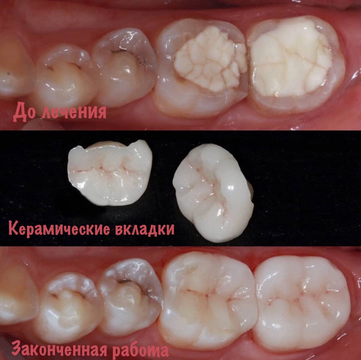 Зубные вкладки — процесс установки | Стоматология «София»