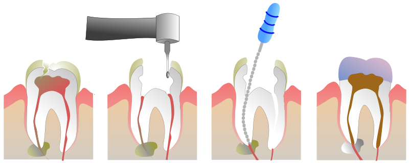 Когда необходимо лечение каналов зуба?
